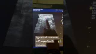 Appendicular mucocele with Appendicolith formation ultrasound surgeon unfrezzmyaccount foryou [upl. by Naor]