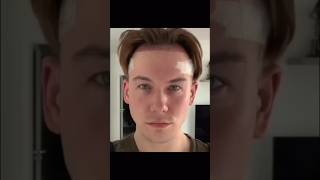 Hair growth timelapse after hair transplant at Vinci Hair vincihairclinic shorts [upl. by Nonnaehr]