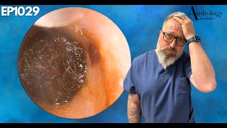 INSANE DEEP EAR WAX PLUG REMOVAL  EP1029 [upl. by Novyak315]