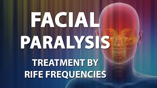 Facial Paralysis  RIFE Frequencies Treatment  Energy amp Quantum Medicine with Bioresonance [upl. by Dewhurst948]