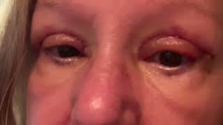 Blepharoplasty Surgery [upl. by Illak693]