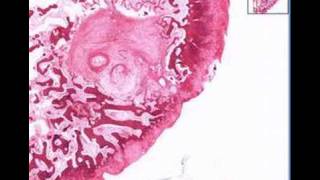 Histopathology BoneOsteoarthritis subchondral cyst [upl. by Ranitta]