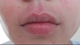 How to get rid of Perioral Dermatitis [upl. by Odlawso]