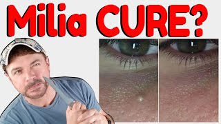 How To Get Rid Of Milia  Hard White Bumps on Face and Eyes  Chris Gibson [upl. by Elum]