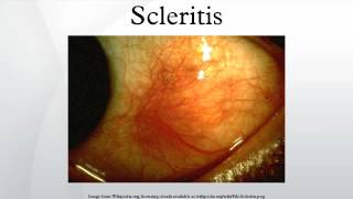 Scleritis [upl. by Riffle]