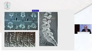 Osteoid Osteoma What Shall I Do by Dr Mohamed Fawzy Khattab [upl. by Loziram]