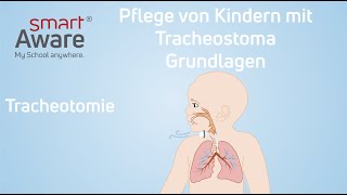 Pflege von Kindern mit Tracheostoma Tracheotomie  Pflegestandards Kinderkrankenpflege  smartAware [upl. by Ardnuek]