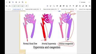 Hemodynamic disorders  hyperamia Thrombus and embolism [upl. by Obediah]