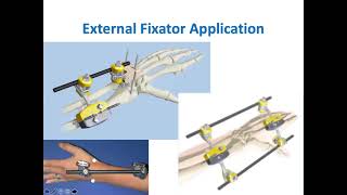 External Fixators in Distal Radius Fractures [upl. by Marshall849]