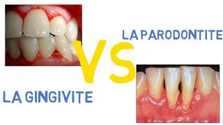 Gingivite VS parodontite [upl. by Kepner]