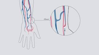 Understanding hemodialysis [upl. by Yroffej]