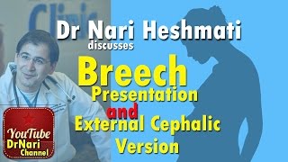 Breech Baby amp External Cephalic Version Discussed by Dr Nariman Nari Heshmati [upl. by Waiter981]