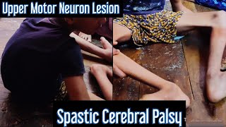 A case of Spastic Cerebral Palsy Upper Motor Neuron Lesion UMNL mbbs next [upl. by Atalaya]