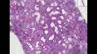 Histopathology KidneyRapidly progressive glomerulonephriti [upl. by Yrellam]