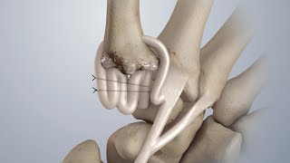 Osteoarthritis of the Thumb Surgical Treatment LRTI [upl. by Larianna]