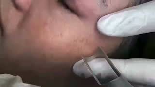 RUIPUFactoryPicolaser skin treatment care wwwruipufactorycom [upl. by Arturo]