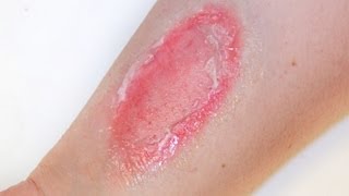 FX MAKEUP SERIES Second Degree Burns [upl. by Kalila]