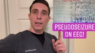 I Recorded a Pseudoseizure on EEG [upl. by Hepza]