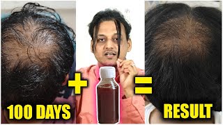 Hair oil and serum 100 days result  I am amazed with the result  India 2024 [upl. by Hollah]