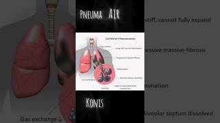 pneumoconiosis occupational lung disorders shortvideo generalknowledge silicosis [upl. by Zobias]