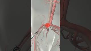 Learn How Cardiac Catheterization Works [upl. by Ecinaj160]