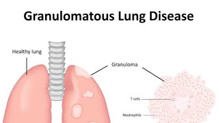 Granulomatous diseases of Lung Introduction [upl. by Ugo]