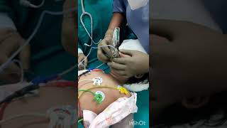 Pediatric LMA Insertion [upl. by Adnolay]