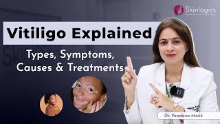 White patches on skin  How to treat white patches on face  Skin Specialist in Noida [upl. by Avilo]