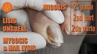 Mycosis and nail lysis Part 2 podology asmr [upl. by Eema127]