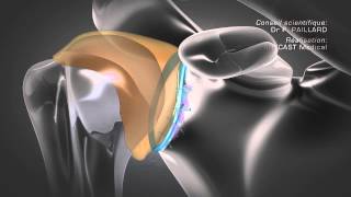 Stabilisation de lépaule [upl. by Colson]