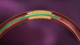 WET 18  Animation of Intracranial angioplasty and stentingmpg [upl. by Anilrats]