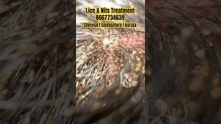 lice removalhow to remove lice from hairlicelice nits treatment now in Coimbatore Chennai Kerala [upl. by Hanauq980]