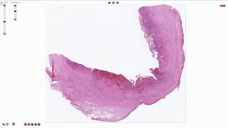 Chronic Cholecystitis with Acute Exacerbation  Histopathology [upl. by Landre]