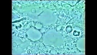 Parodontite de grossesse  biofilm sous épulis [upl. by Klug931]