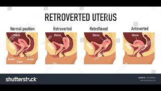 Anteverted Uterus  Symptoms and Causes  Diagnosis  Treatment  Prevention [upl. by Jaycee]