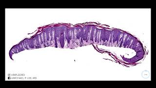 Psoriasis versus nummular dermatitis Dermpath made easy [upl. by Anaitat835]