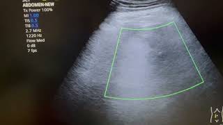 헉 부신종양 우연종adrenal gland incidentaloma [upl. by Llenyaj572]