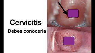 Cervicitis  Causas síntomas diagnóstico y tratamiento  ETS [upl. by Ajiak756]