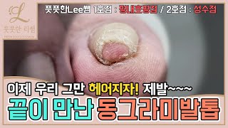 ENG SUB끝이 만난 동그라미발톱 이제 그만 헤어지자 ingrown toenail  ingrowing nail  Fresh Foot 풋풋한리쌤 성수점  평내호평점 [upl. by Arihk]