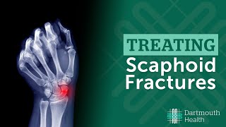 Treating Scaphoid Fractures at Dartmouth Health [upl. by Jean78]