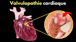 Comment se produit la valvulopathie cardiaque  Symptômes diagnostic et traitement [upl. by Eyatnod]