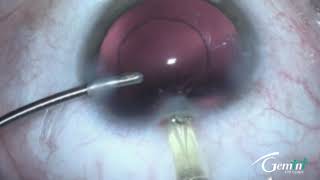 FINEVISION HP implantation by Dr Stodulka [upl. by Hairahcez]