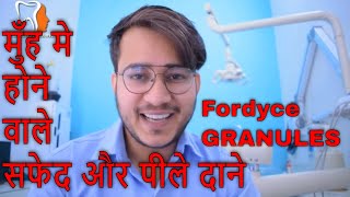 मुँह मे होने वाले सफेद और पीले दाने  Fordyce SpotsGRANULES IN MOUTH AND GENITALSDRCHANDER UDHEY [upl. by Derick874]