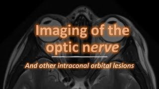 Imaging of the optic nerve [upl. by Atilrahc123]