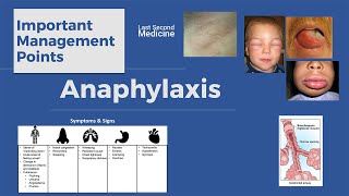 Anaphylaxis  Important Management Points [upl. by Retsila375]