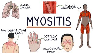 Understanding Myositis Polymyositis and Dermatomyositis [upl. by Clippard]