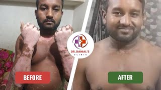 Transformative 5Month Vitiligo Treatment Journey  Dr Danials Clinic Review [upl. by Oikim]