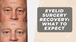 Eyelid Surgery Recovery What To Expect [upl. by Essinger]