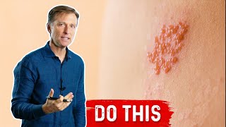 How to Deal With Ringworm Naturally [upl. by Depoliti]