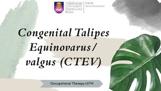 LESSON 8 CONGENITAL TALIPES EQUINOVARUSVALGUS CTEV [upl. by Peoples4]